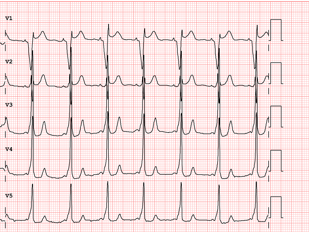 The ECG is probably the single most important screening tool for Brugada pattern or Brugada Syndrome.