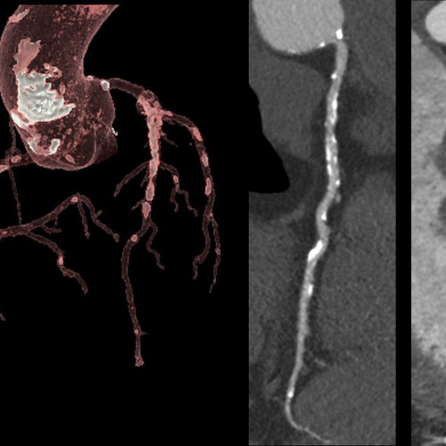 heart clinical image with cardiac ct technology