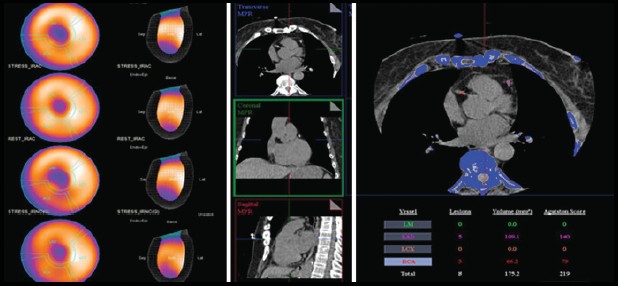 MPI SPECT & CaSc.jpg