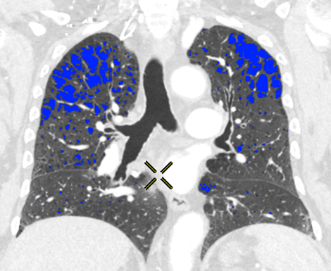 CT-Lunge-Emphysemquantifizierung.png