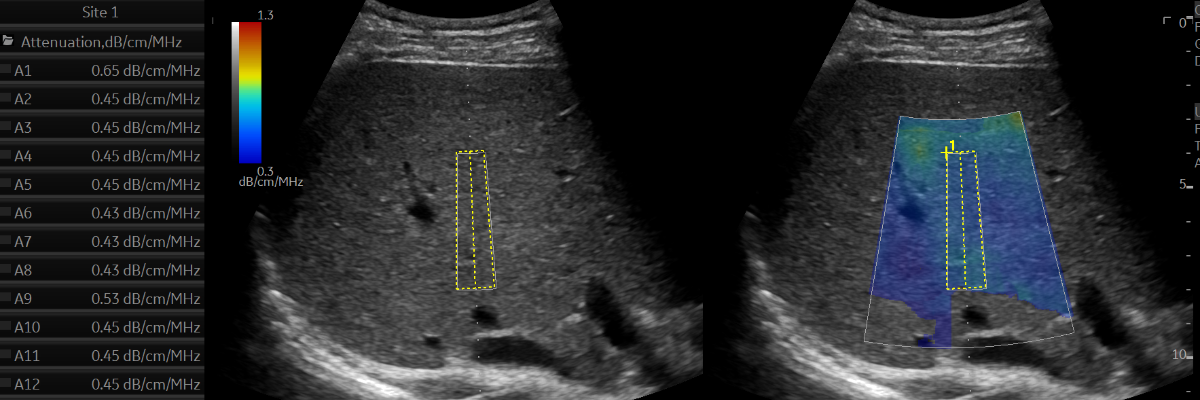 Abdomen Ultrasound image