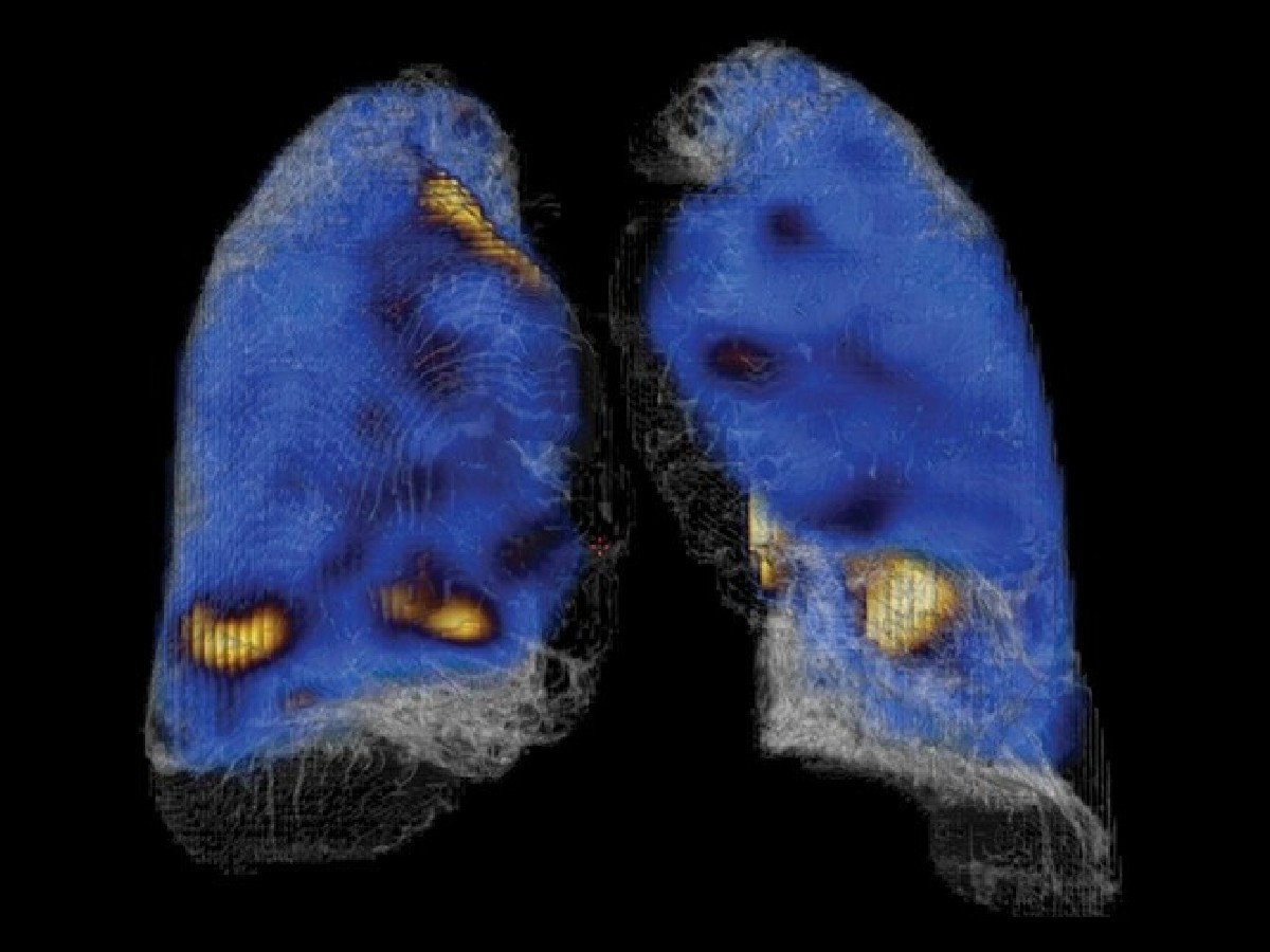 CZT-based hybrid SPECT/CT imaging for pulmonary care.