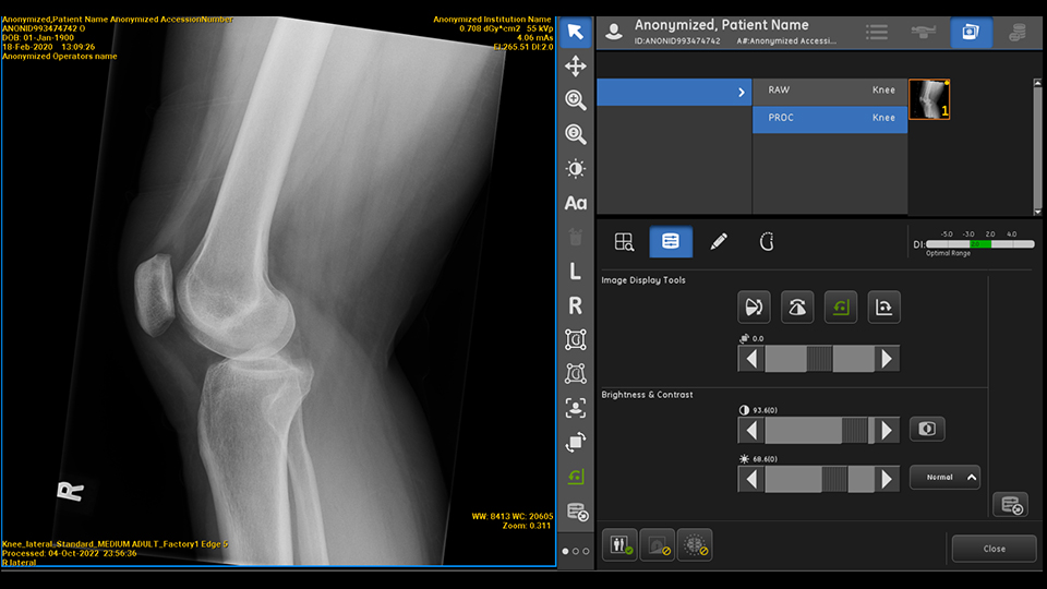 clinical x-ray image of a knee