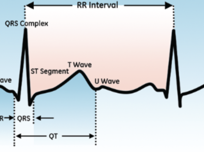 QT Interval measurement on ECG