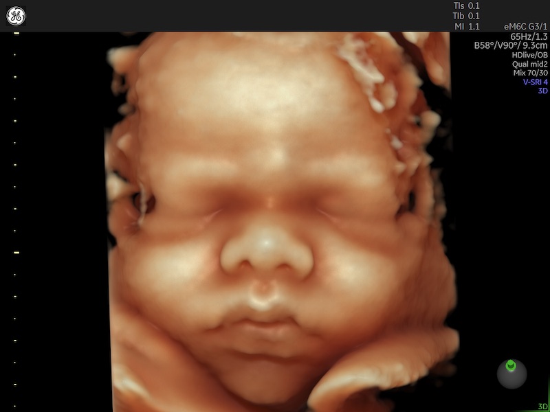 31 week fetal face.jpg