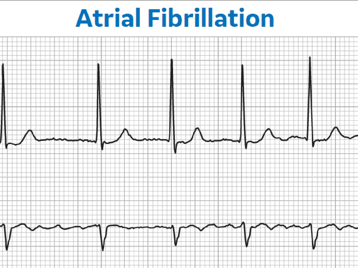 Atrial Fibrillation Vs Atrial Flutter Ecg