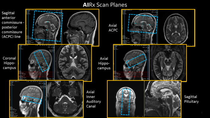 No matter how you slice it, this AI tech is changing MR neuro imaging