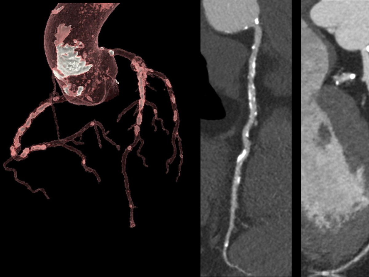 heart clinical image with cardiac ct technology