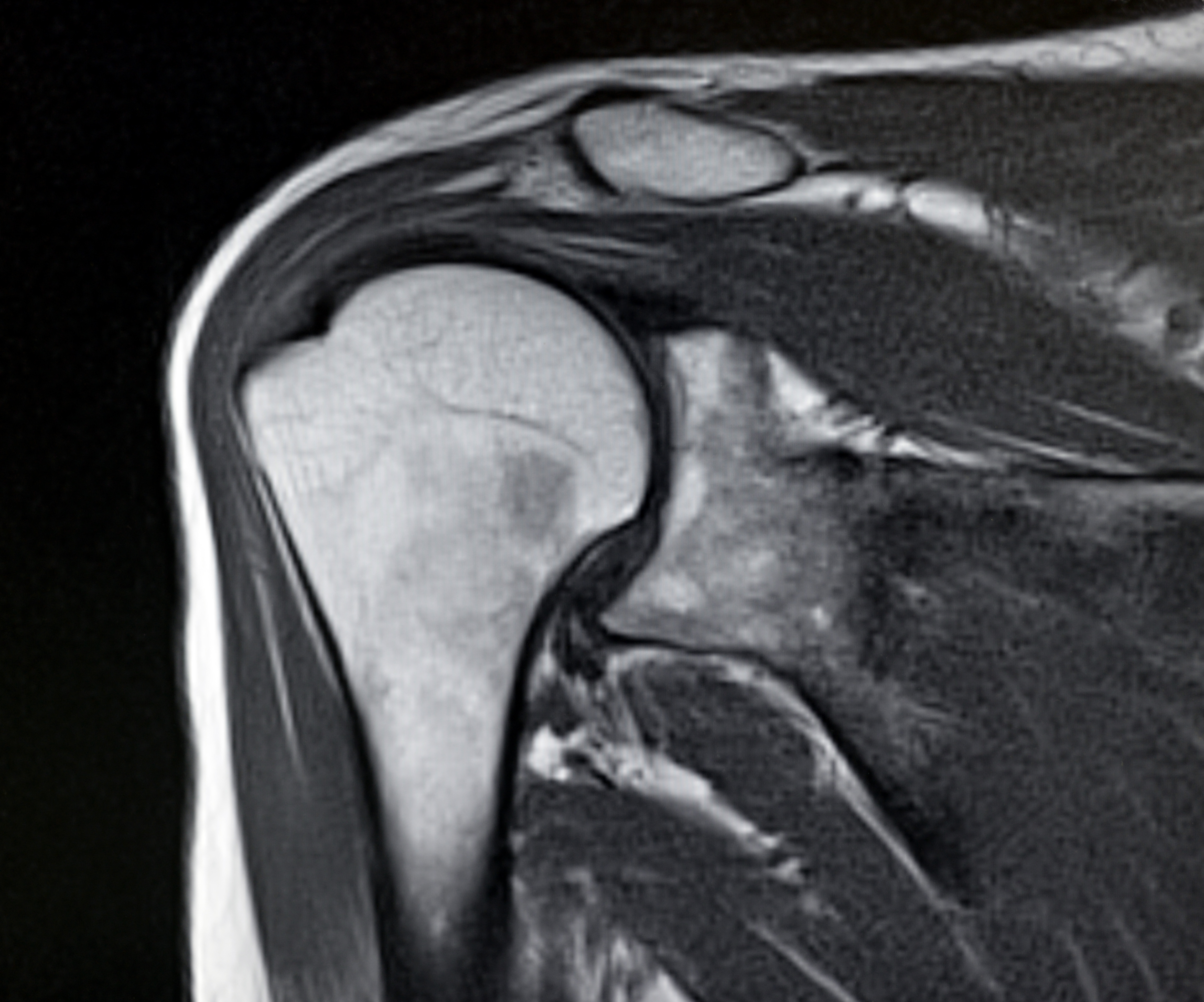 coronal right shoulder MRI image show head of humerus and supraspinatus tendon
