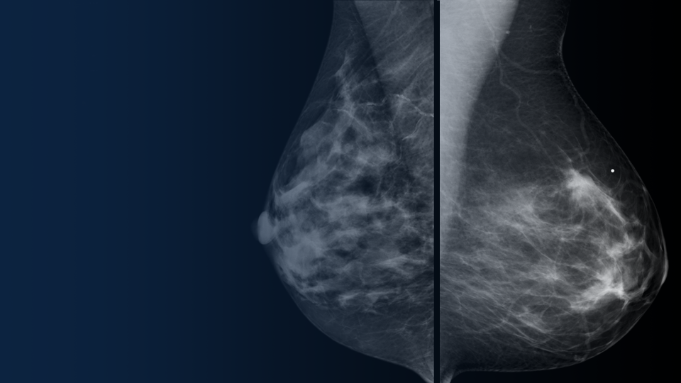 Clinical image of the breast