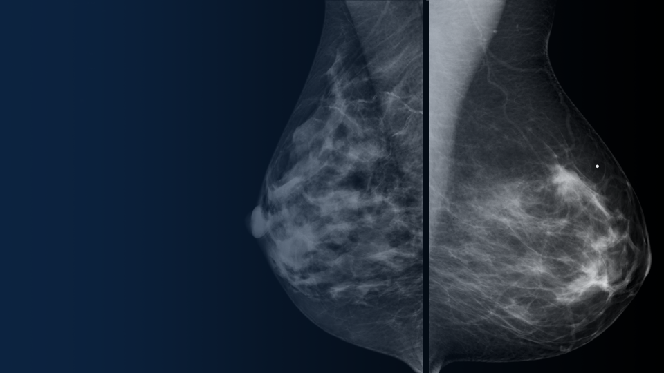 Can a Radiologist Diagnose Breast Cancer from Imaging Tests Alone?