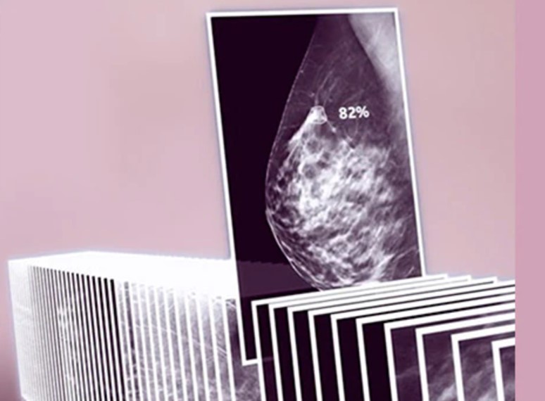 Breast density — The four levels - Mayo Clinic