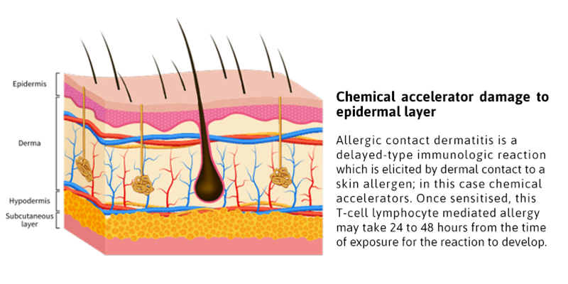 Ilustración transversal de la piel humana que muestra la epidermis, la dermis, la hipodermis y la capa subcutánea.El texto explica que los aceleradores químicos pueden causar dermatitis alérgica de contacto, una reacción inmunitaria retardada mediada por células T en la capa epidérmica, que suele producirse entre 24 y 48 horas después de la exposición.