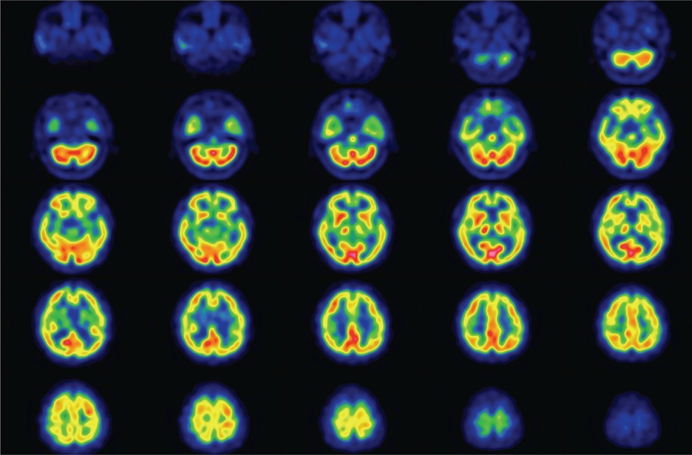 Series of nuclear medicine clinical scans of brain to help illustrate impact of CZT detection in neurology care.
