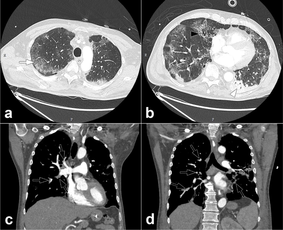CT pulmonary angiography.jpg