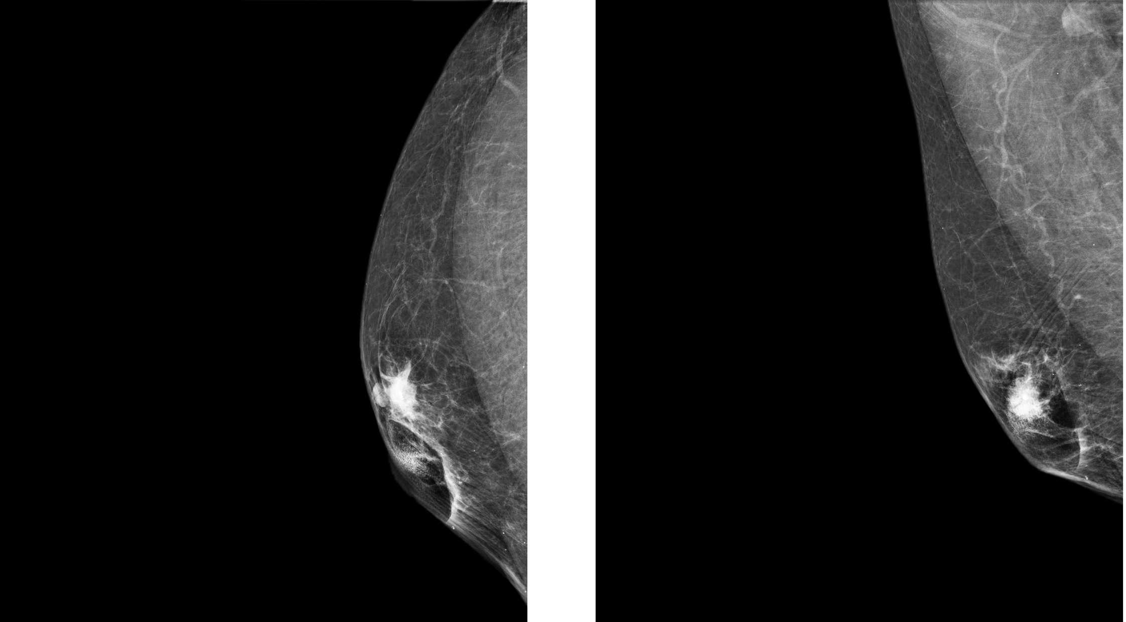 Male Breast Cancer.jpg