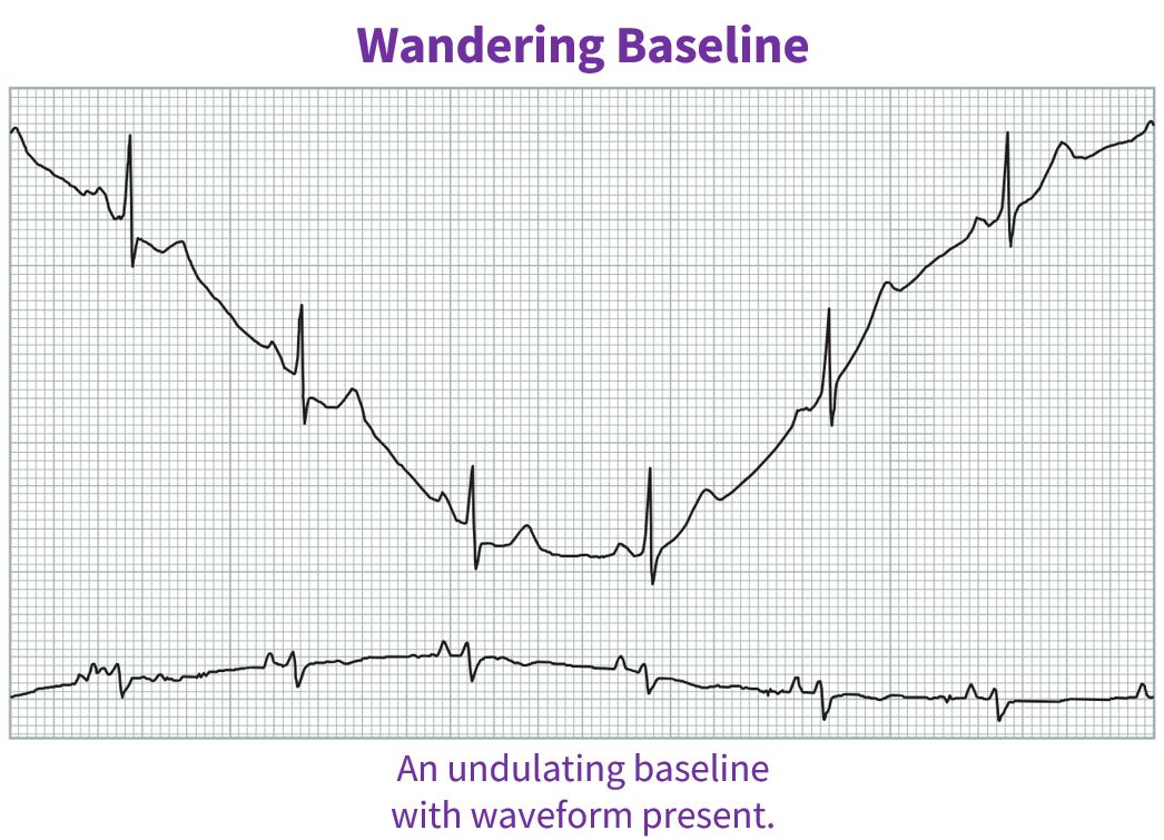 An undulating baseline with waveform present