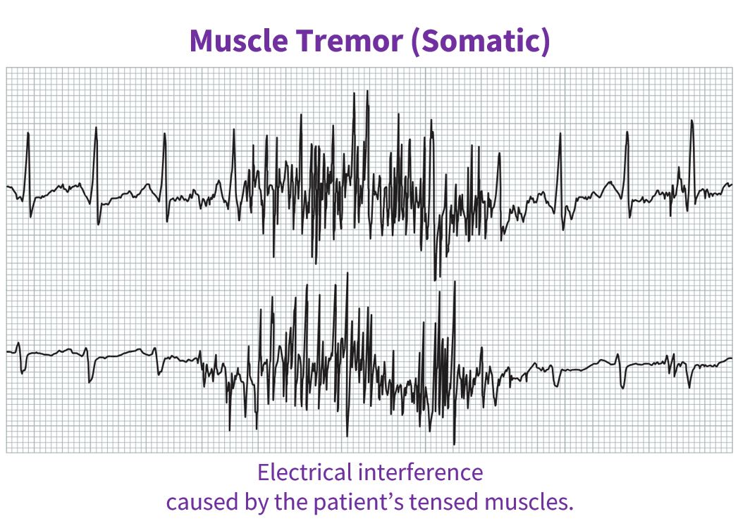 Electrical interference caused by the patient's tensed muscles