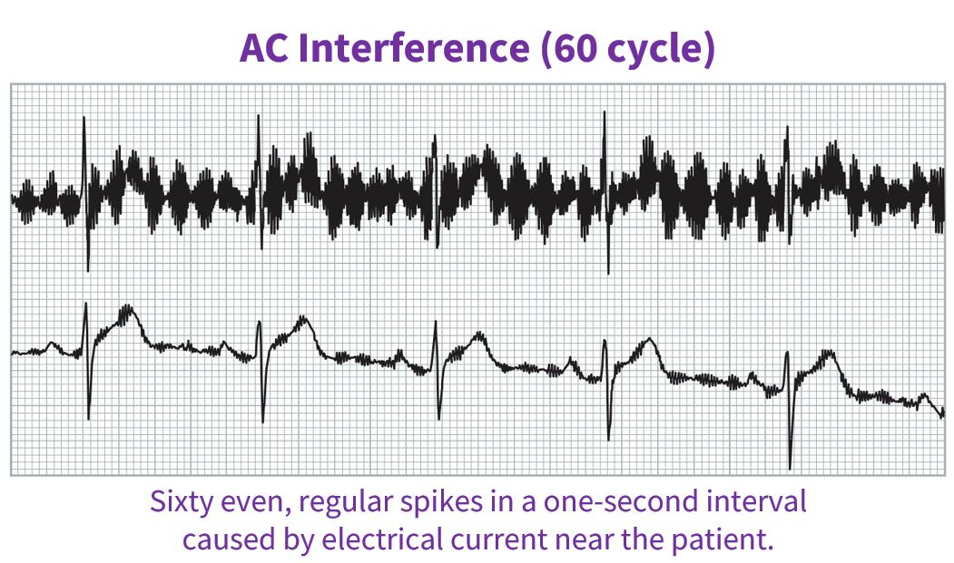 Sixty even, regular spikes in a one-second interval caused by electrical current near the patient