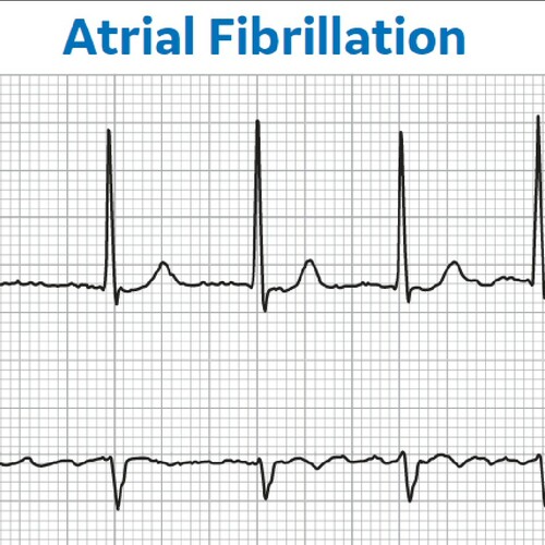 No Afib Symptoms: Risks of Undiagnosed Afib | GE Healthcare (Malaysia)