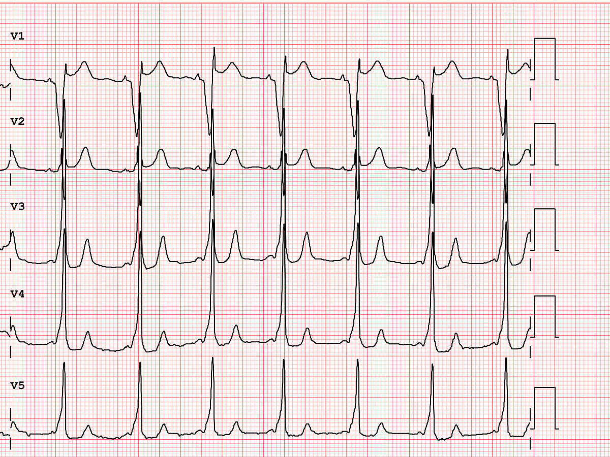 The ECG is probably the single most important screening tool for Brugada pattern or Brugada Syndrome.