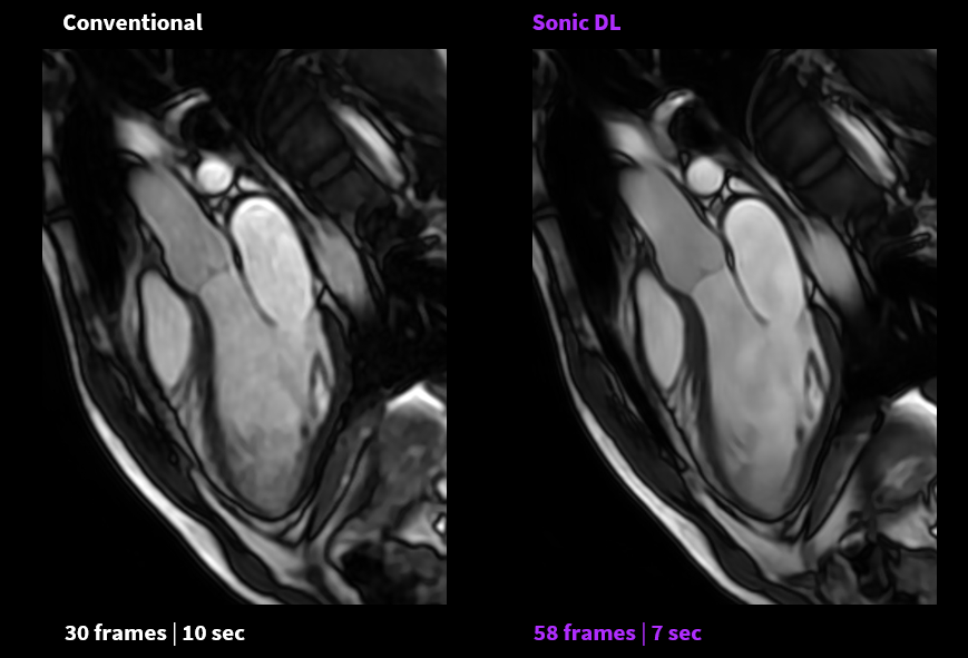 DEEP LEARNING ENHANCES MR SCAN SPEED TO A SINGLE GE HealthCare   Zz1kYzNmMzUxMDA2MDgxMWVlOWY0YzZhNDJjM2IzYzQ5Nw==