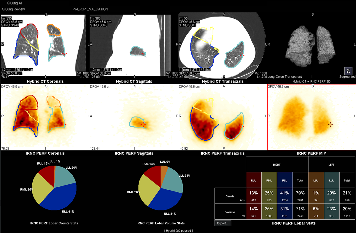 clinical image lung cancer SPECT CT