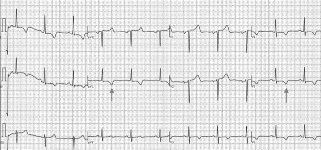 Strain as Predictor of Outcomes: ECG LVH Criteria beyond Voltage | GE ...