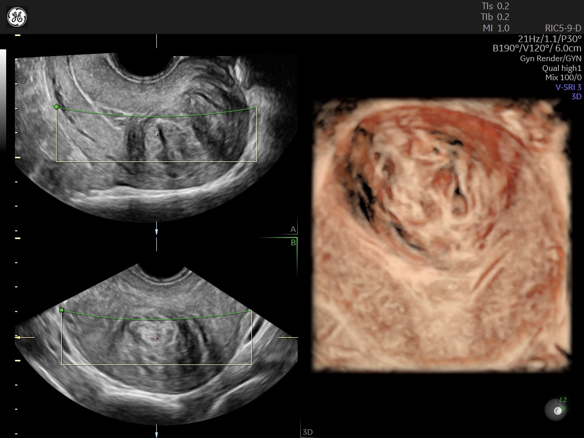 uterine fibroid.jpg