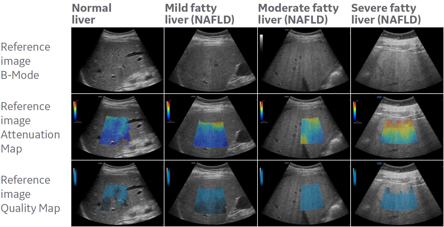 fatty liver ultrasound